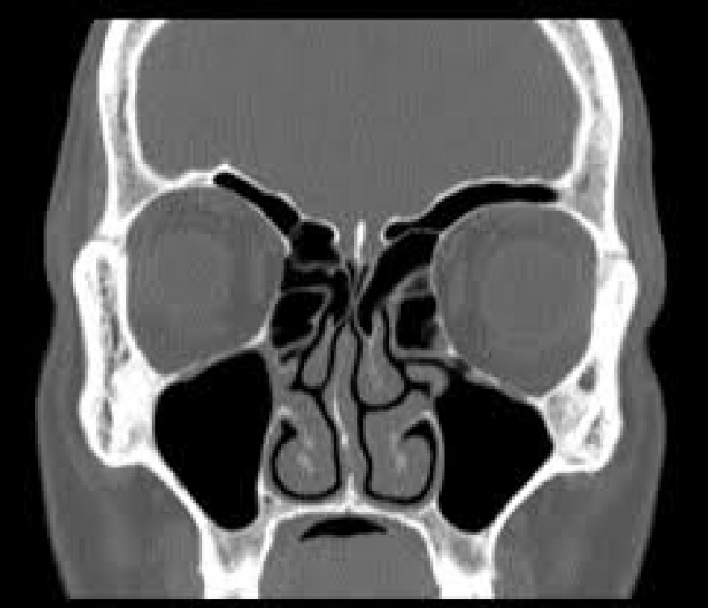 Xray of Sinus cavitites