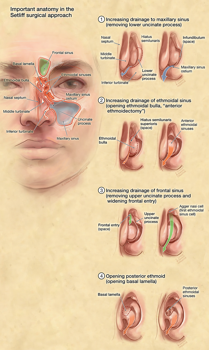 Dr Reuben Setliff's surgical techniques